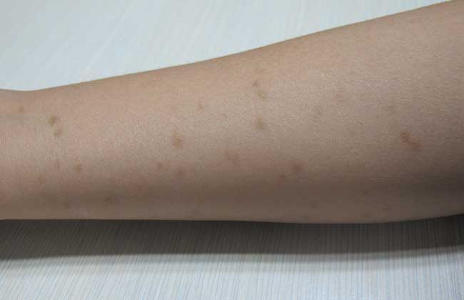 扁平疣可以治愈吗?